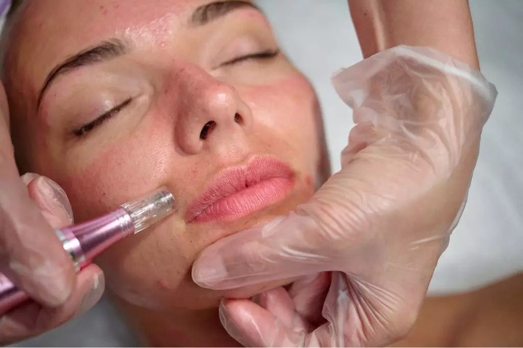 microneedling_with_prp_vs_microneedling